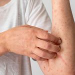 Imagem ilustrativa de Erupções cutâneas: Lesões na pele causadas pela MPOX.