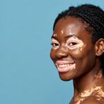 vitiligo tratamento individualizado