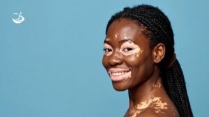 vitiligo tratamento individualizado